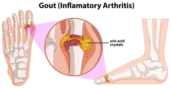 Uric Acid: Problem and Treatment